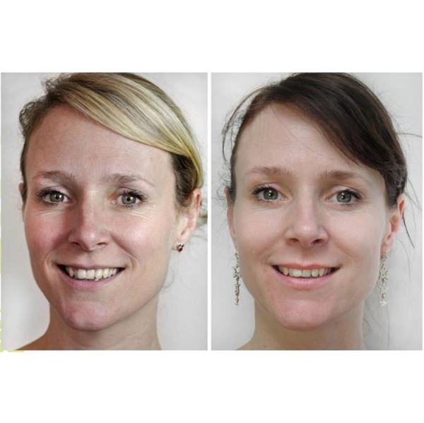 Dermaroller 540 Nadeln mit Titannadeln 0,5 mm für das Gesicht – | Fashiongirl