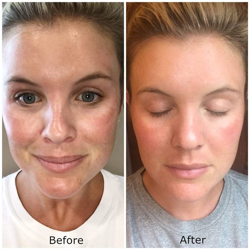 Dermaroller 540 Nadeln mit Titannadeln 0,5 mm für das Gesicht – | Fashiongirl