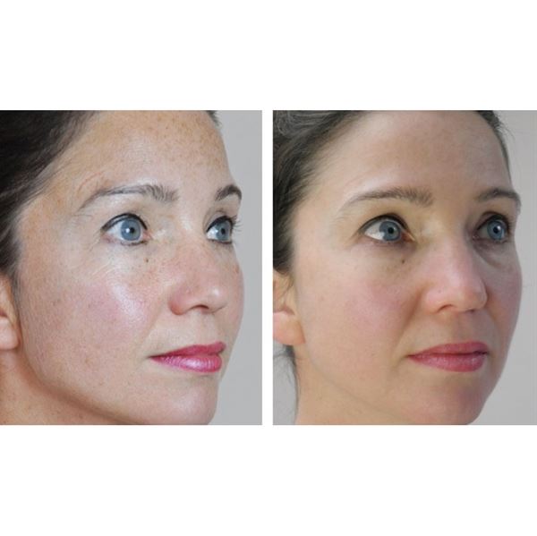 Dermaroller 540 Nadeln mit Titannadeln 0,5 mm für das Gesicht – | Fashiongirl