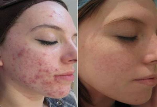 UNIQ Titanium Dermaroller 540 Nadeln 0,25 mm für das Gesicht – | Fashiongirl