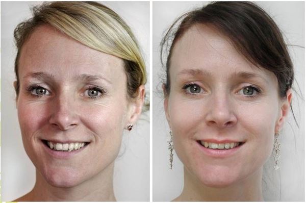 UNIQ Titanium Dermaroller 540 Nadeln 0,25 mm für das Gesicht – | Fashiongirl