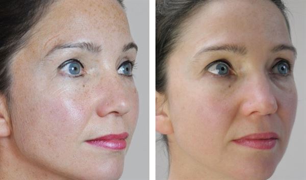 UNIQ Titanium Dermaroller 540 Nadeln 0,25 mm für das Gesicht – | Fashiongirl